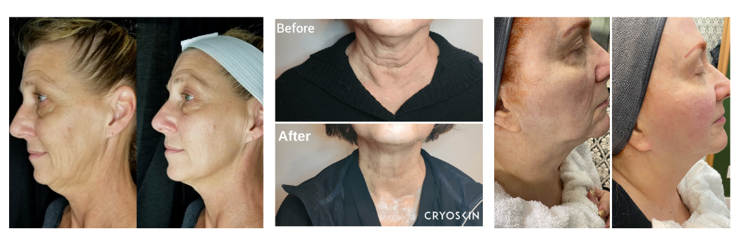 CryoFacial Before and After
